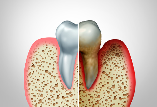 periodontal disease