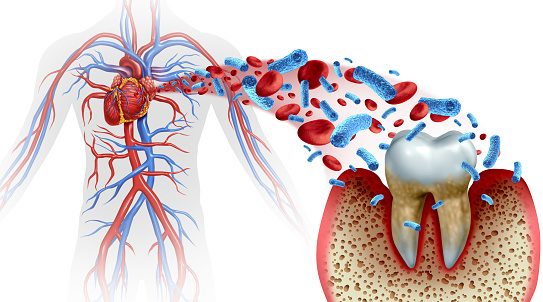 preodontal disease