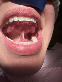tongue tie release