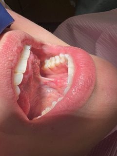 tongue tie release