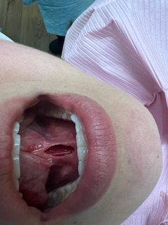tongue tie release