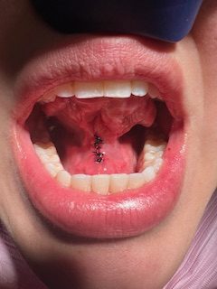 tongue tie release